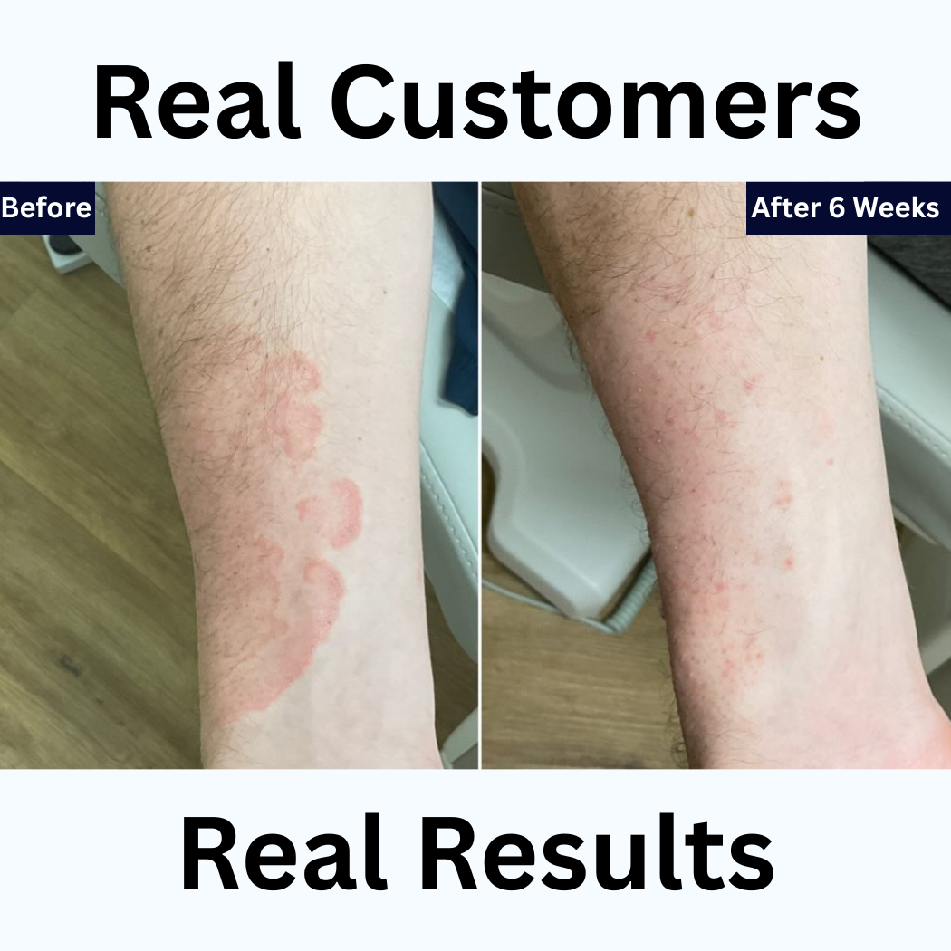 Antifungal Treatment Pen