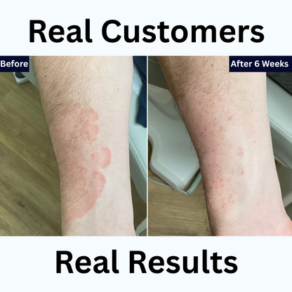 Antifungal Treatment Pen